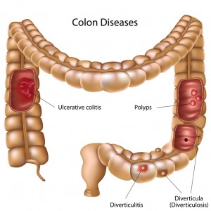 Am Crohns Disease Ulcerative Colitis Pregnancy