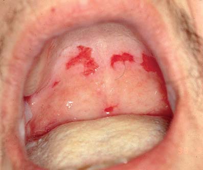 Oral PV