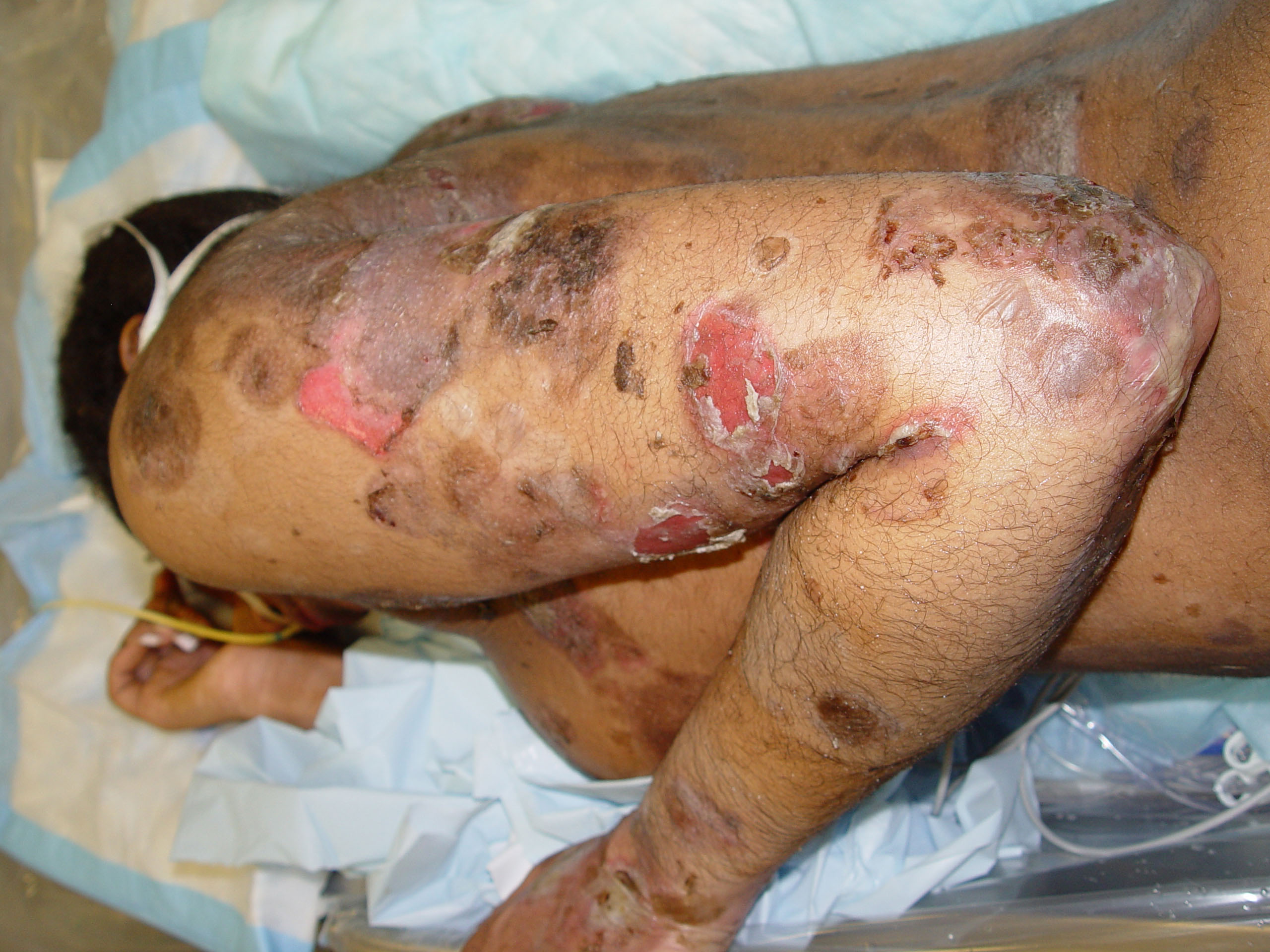 pemphigus vulgaris