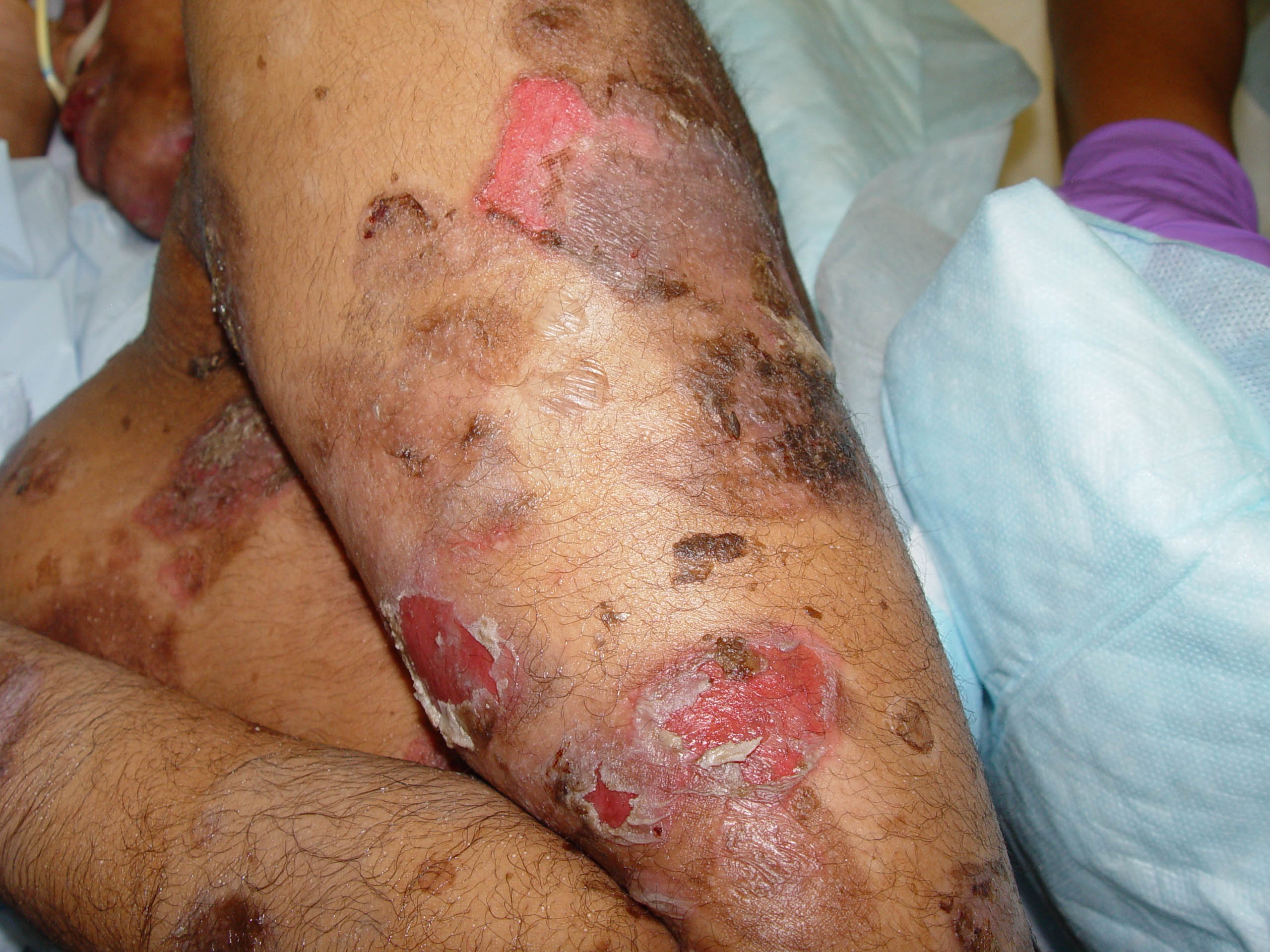 Pemphigus vulgaris on the leg